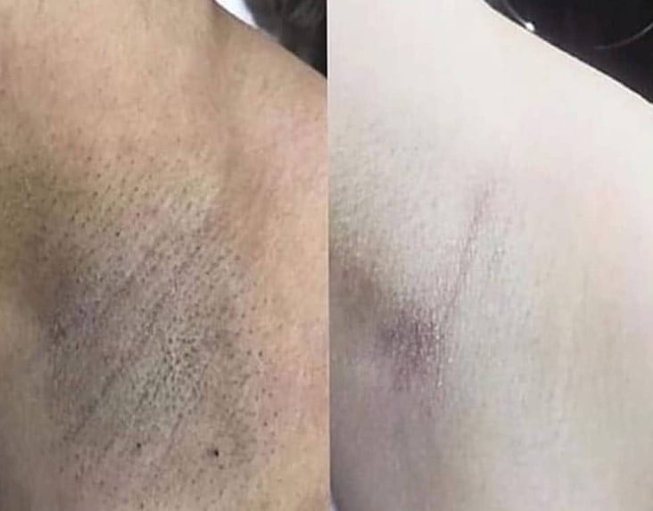 Kıl Dönmesinde Lazer Epilasyonun Faydası