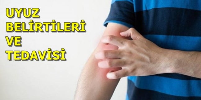 UYUZ HASTALIĞI NEDİR? NASIL TEDAVİ EDİLİR?