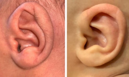 BEBEKLERDE KULAK ŞEKİL BOZUKLUKLARI TEDAVİSİ NASIL YAPILIR?