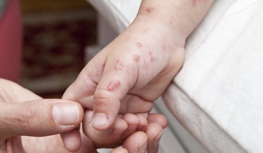 Türkiye&#8217;de ilk maymun çiçeği vakası görüldü